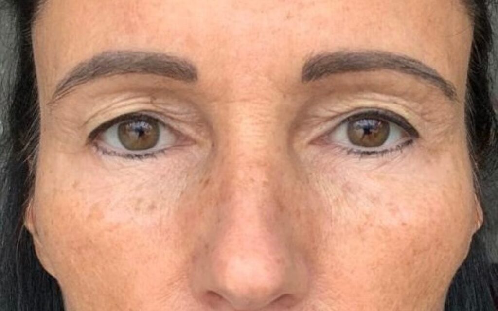 Augenlidstraffung nachher: verjüngte, wache Augen nach der Lidstraffung bei OA Dr. René Kaplan
